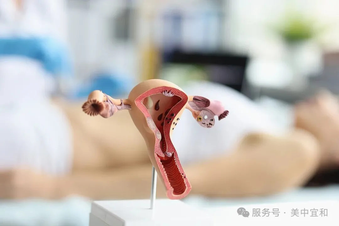 子宫解剖模型示意 — 经脐单孔腹腔镜肌瘤剔除术