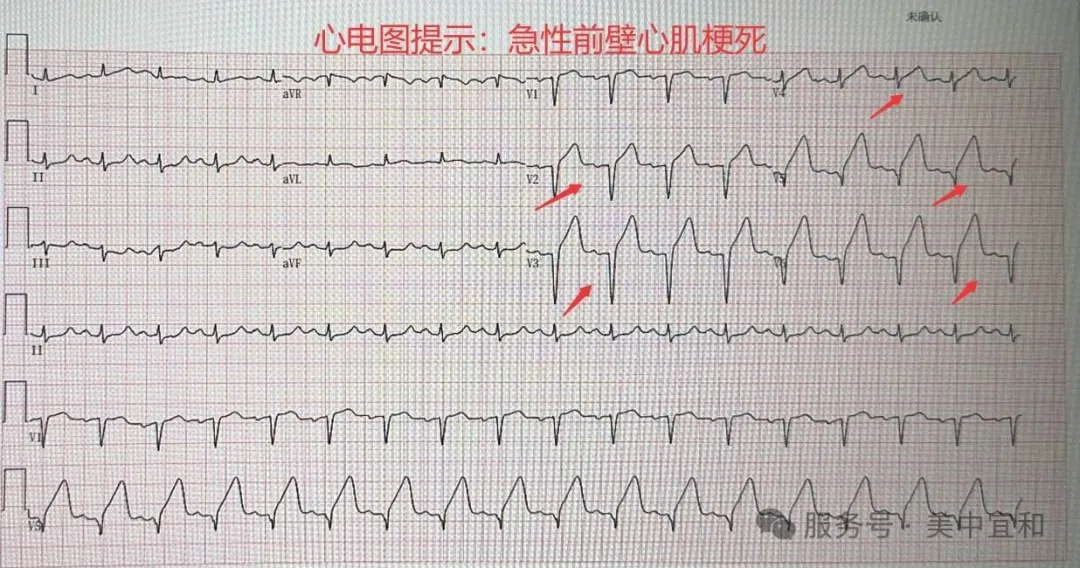 ECG showing acute anterior wall myocardial infarction with ST-segment elevation