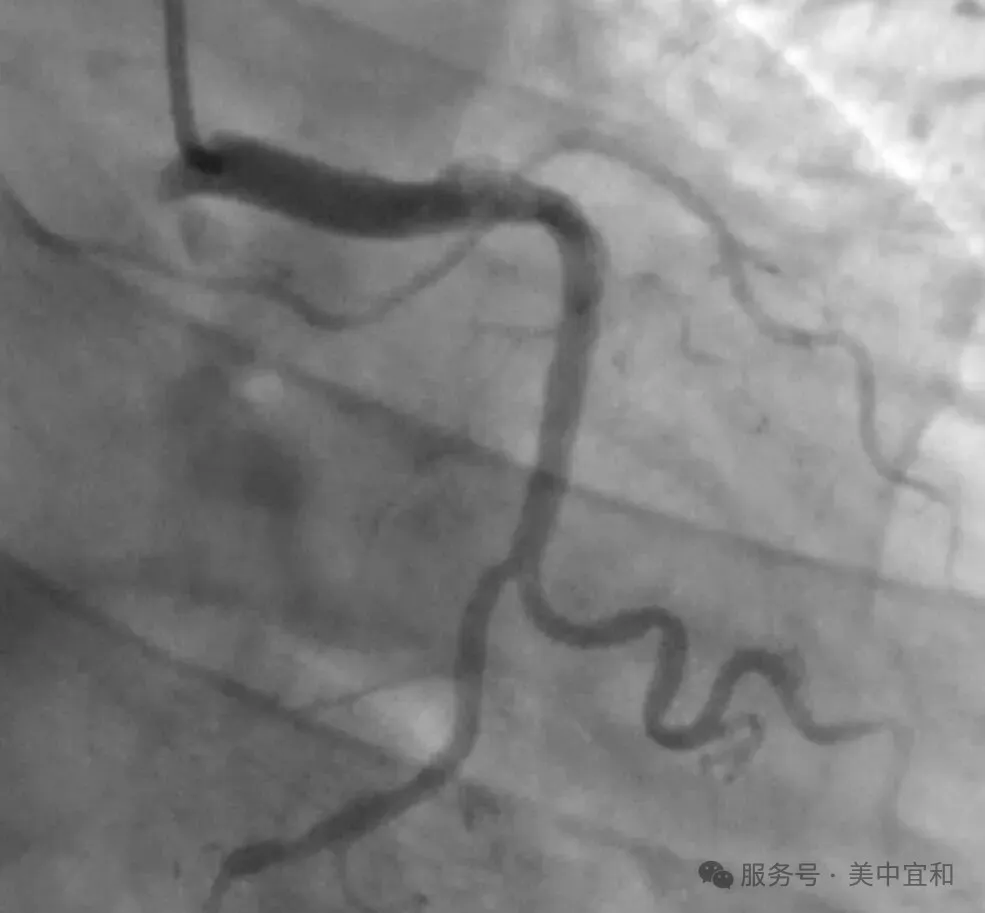 Coronary angiogram showing restored blood flow in the left anterior descending artery after PCI