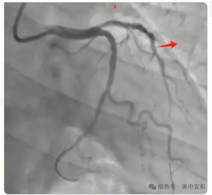 Coronary angiogram showing total occlusion of the left anterior descending artery before PCI