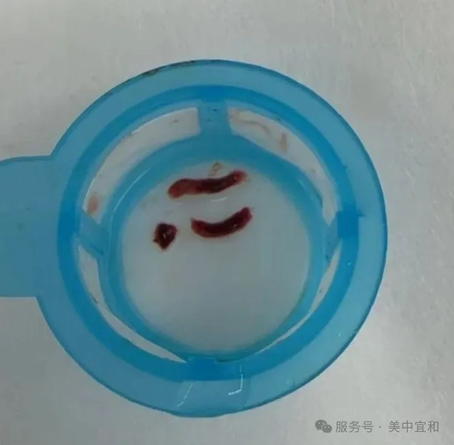 Thrombus aspirated from the coronary artery during PCI
