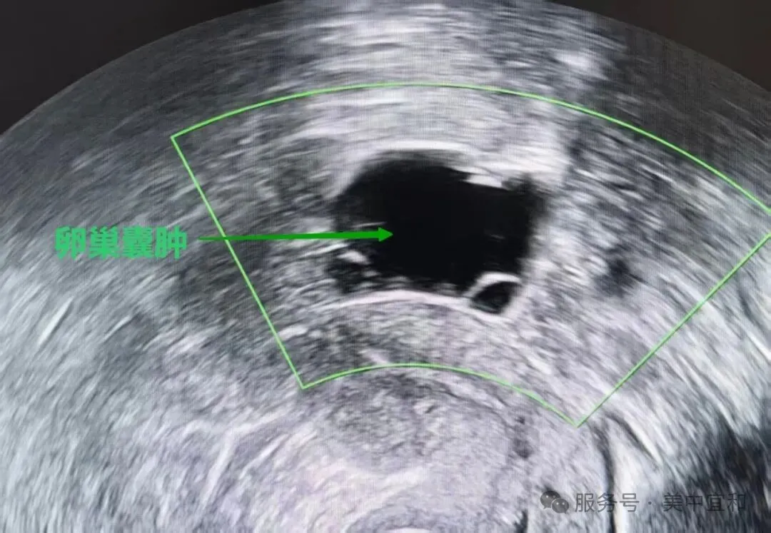Ultrasound image showing an ovarian cyst