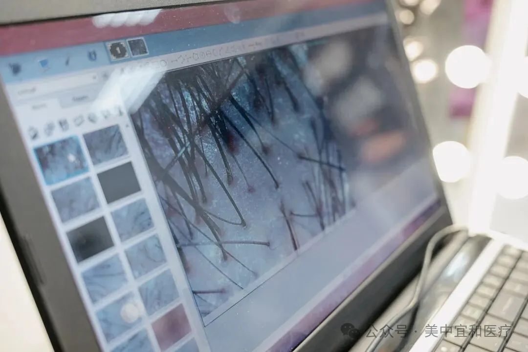 Trichoscopy and digital hair follicle analysis at the AMCARE Beijing Scalp Medical Center