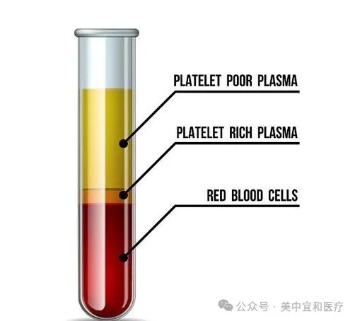 Blood sample separated by centrifugation into platelet-poor plasma, platelet-rich plasma and red blood cells for PRP therapy