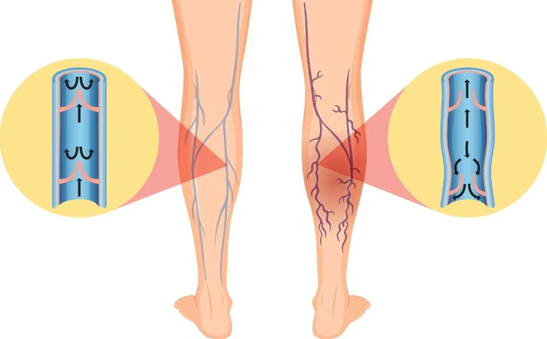 Varicose veins and venous valve insufficiency medical illustration