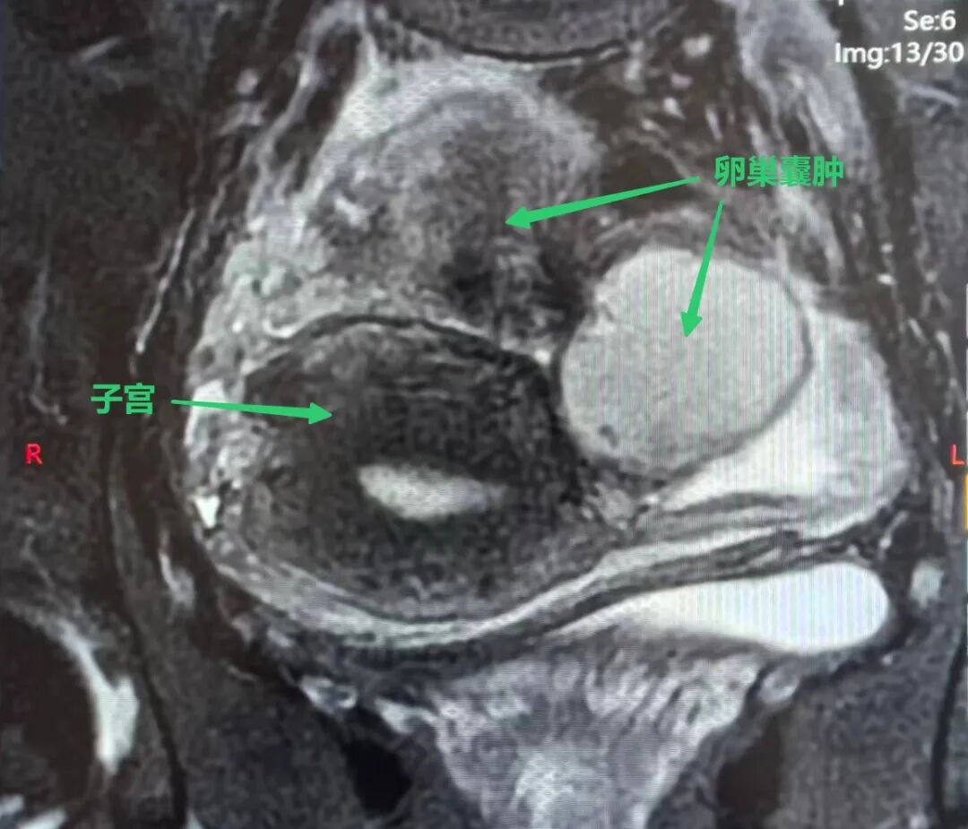 Pelvic MRI showing an ovarian cyst and the uterus