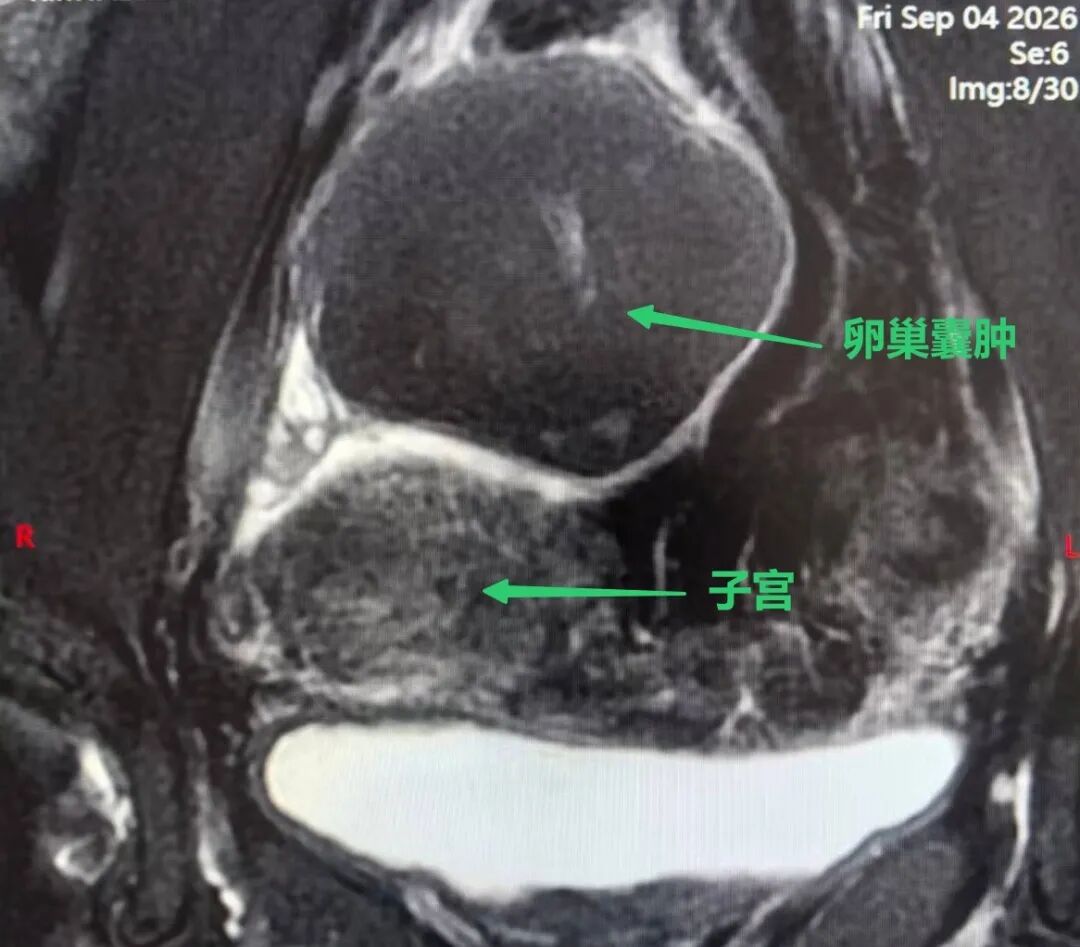 MRI showing a right ovarian cyst larger than the uterus