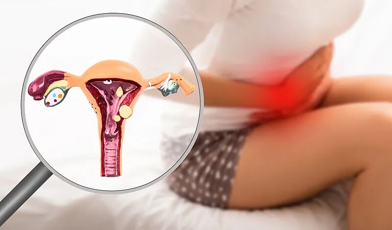 Anatomical illustration of the uterus and ovaries with a magnified view of endometriosis