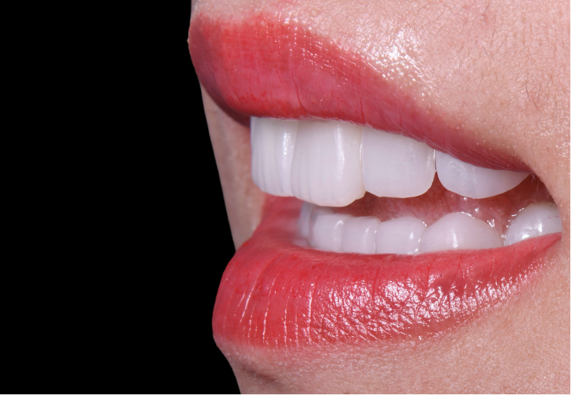 Close-up of a natural-looking porcelain veneer result, seen from the side while smiling