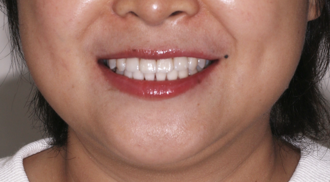 Frontal view of a patient smiling, used to judge how many teeth have been restored
