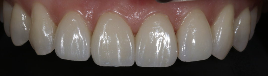 Close-up of the four restored upper incisors after treatment
