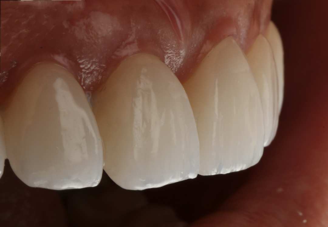Macro photograph showing the layered translucency and surface texture of porcelain veneers on upper incisors